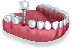Dental implant model showing titanium post, crown, and natural teeth on gum replica.