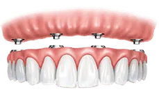 Dental implant prosthetic showing gum tissue and replacement teeth structure model.