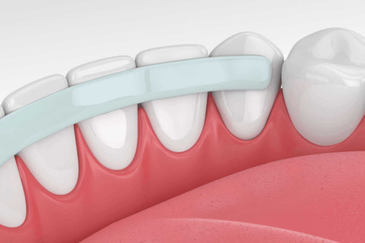 When Is Dental Bonding the Better Choice Than Veneers in Bel Air?