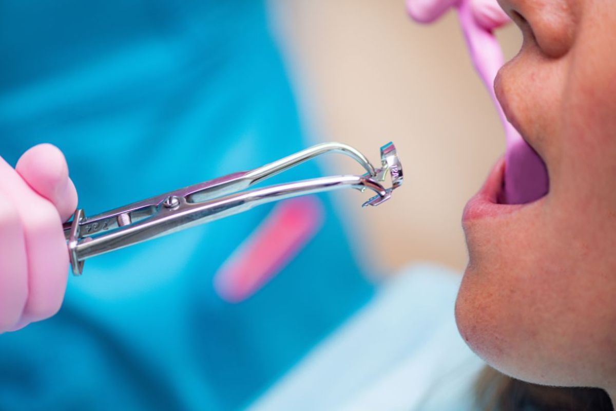 When Is a Tooth Extraction Necessary in Bel Air?